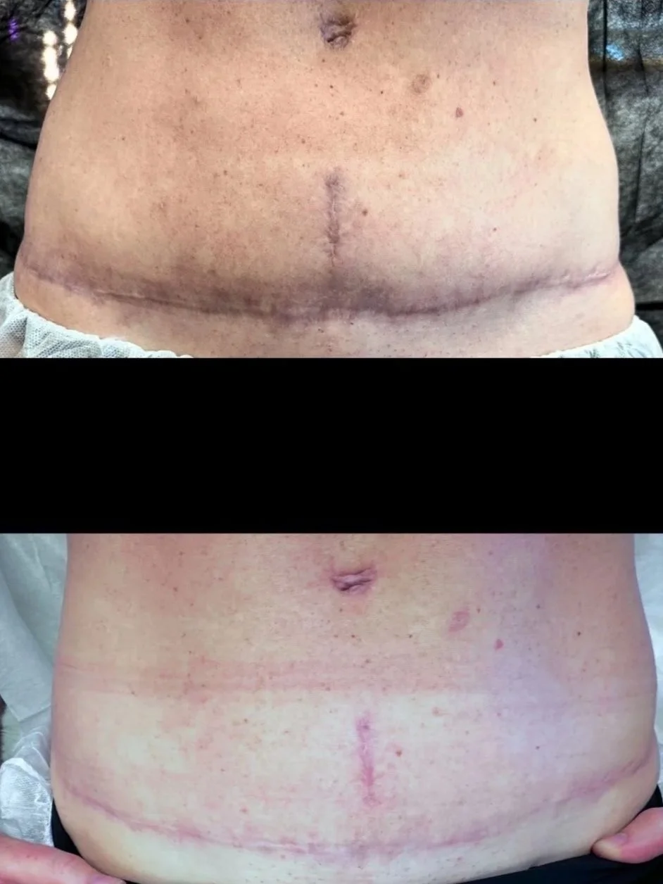 Comparison of a person's abdomen showing scars from surgery, before and after healing.