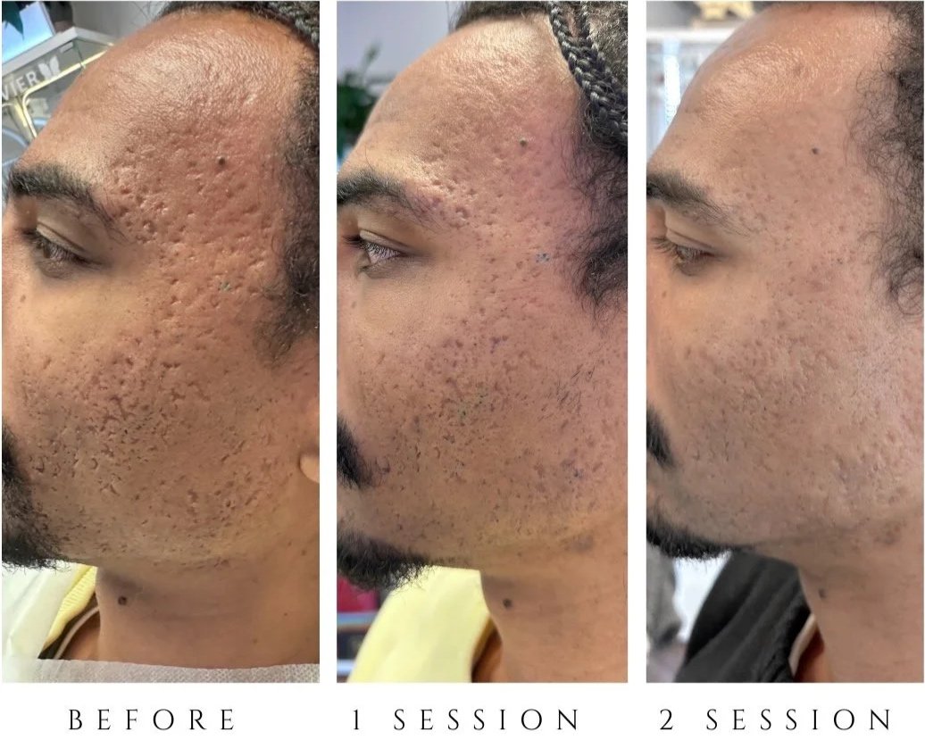 Progression of a person's face showing improvement in skin condition over three stages: before treatment, after one session, and after two sessions, with visible reduction in acne scars and skin texture.