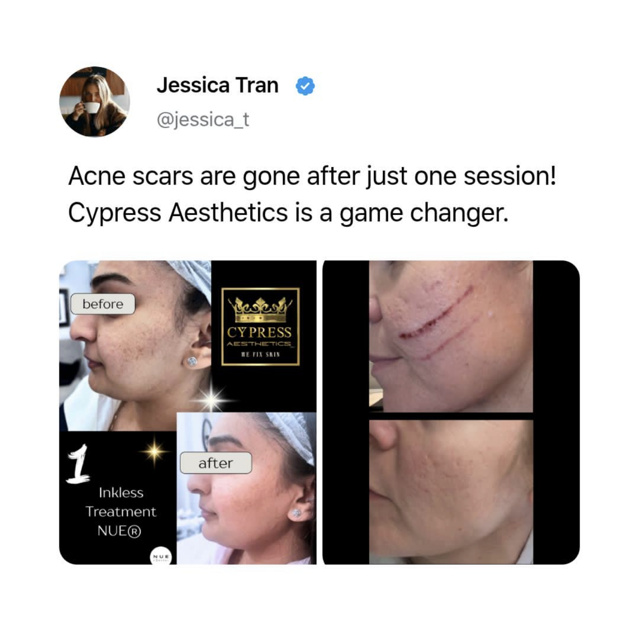 Social media post showing before and after photos of a woman's face, highlighting skin improvement after acne treatment at Cypress Aesthetics. The post includes text stating acne scars are gone after one session and promoting the clinic as a game changer for skin issues.