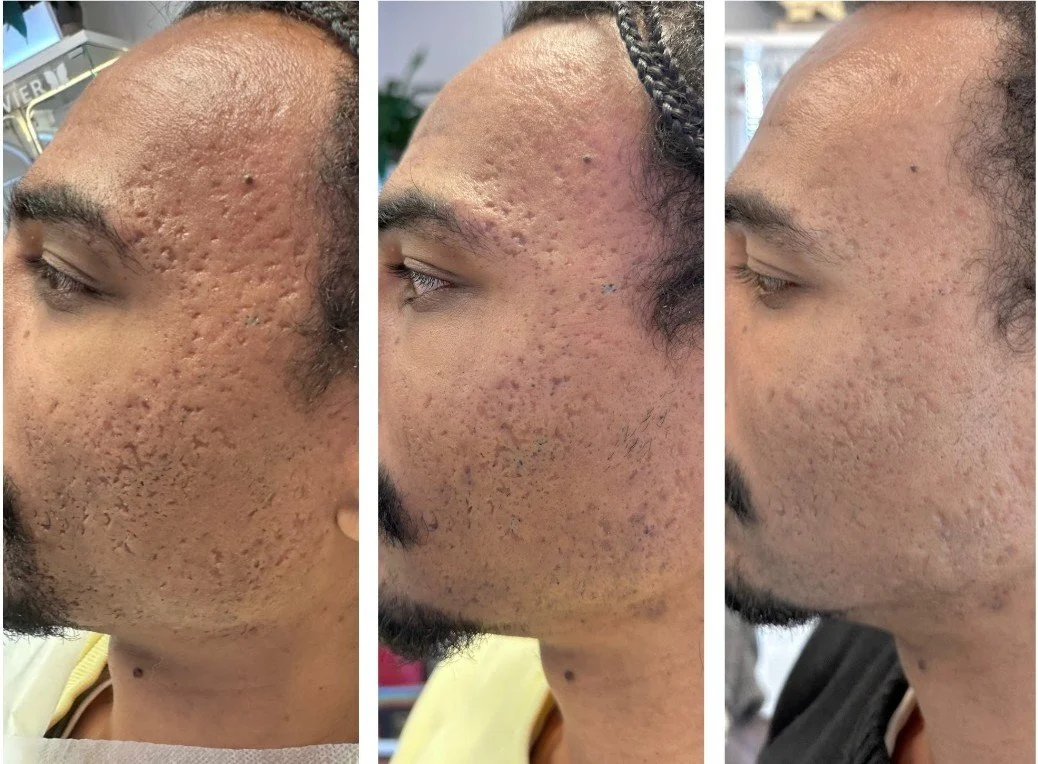 Side profile of a person with improving acne scars on their face, shown in three stages from left to right.