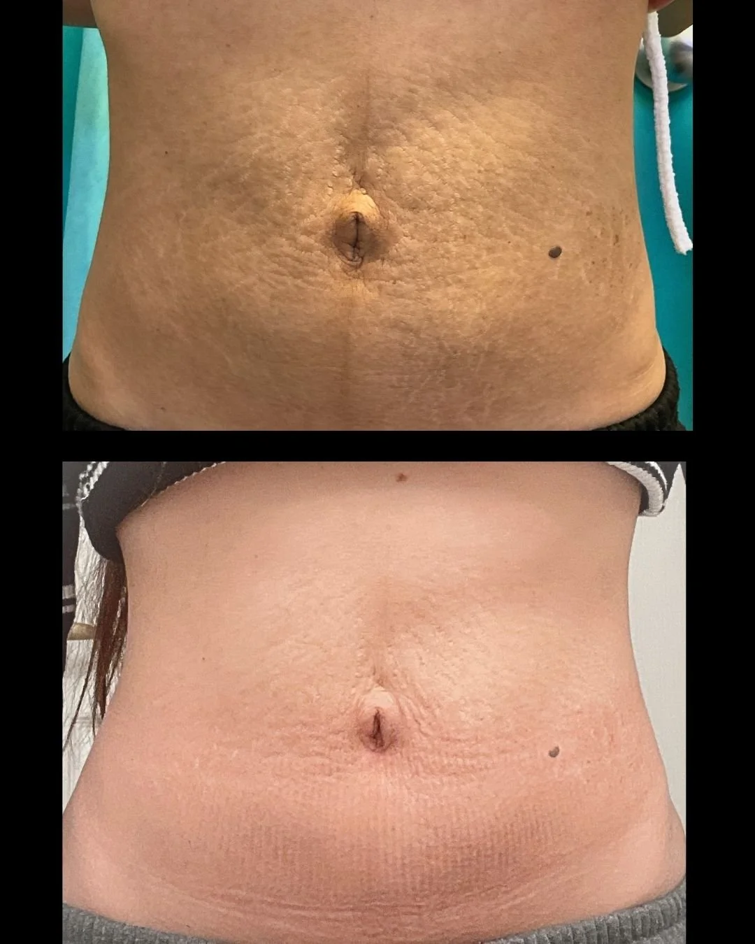 Comparison of a person's abdomen before and after treatment, showing skin improvement and reduction of abdominal scars or stretch marks.