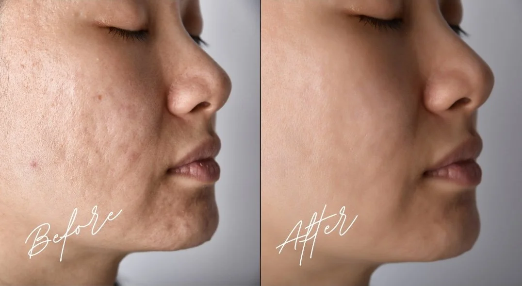 Side-by-side comparison of a woman's face showing her skin before and after clear skin treatment, with 'Before' and 'After' labels. Cypress Aesthetics Acne Scar Transformation.