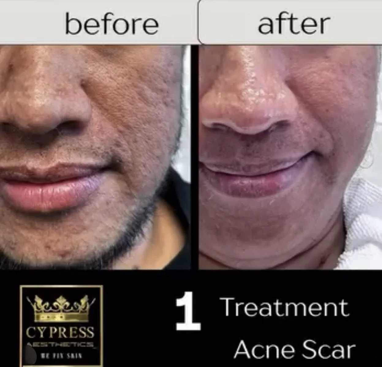 Before and after photos showing improved skin from acne scar treatment. The left image shows face with acne scars, the right with clearer skin. Cypress Aesthetics logo at bottom left. After only 1 treatment at Cypress Aesthetics Inc.