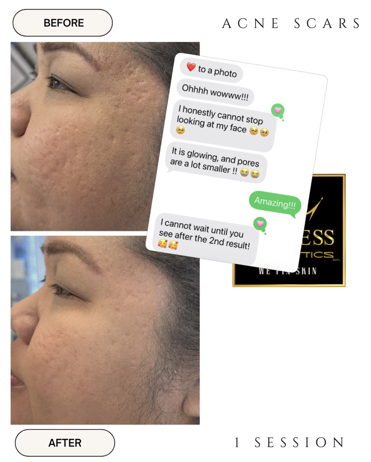 Side-by-side comparison of a person's face showing facial acne scars before and after skincare treatment, with a chat overlay praising the results after one session.