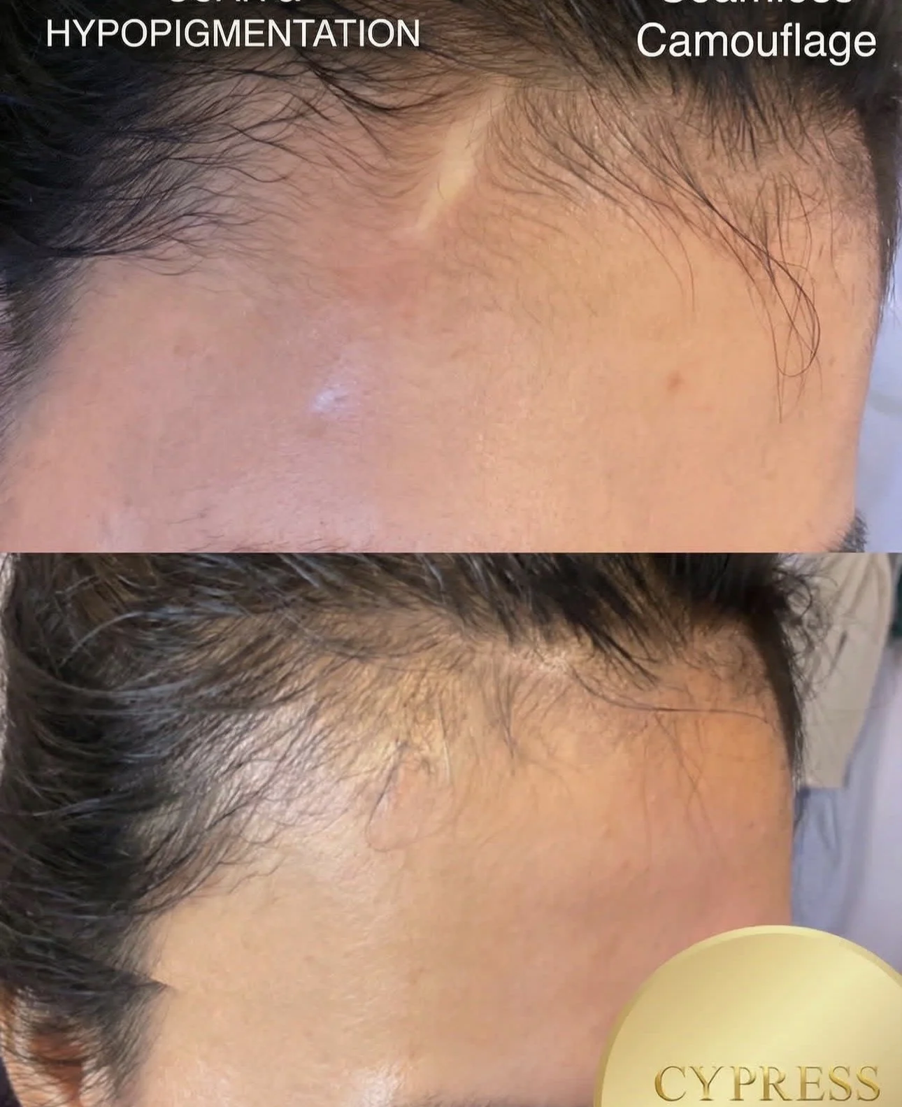 Comparison of hairlines showing hypopigmentation and camouflage; the top image shows lighter skin with hypopigmentation, the bottom image shows a natural hairline after treatment.