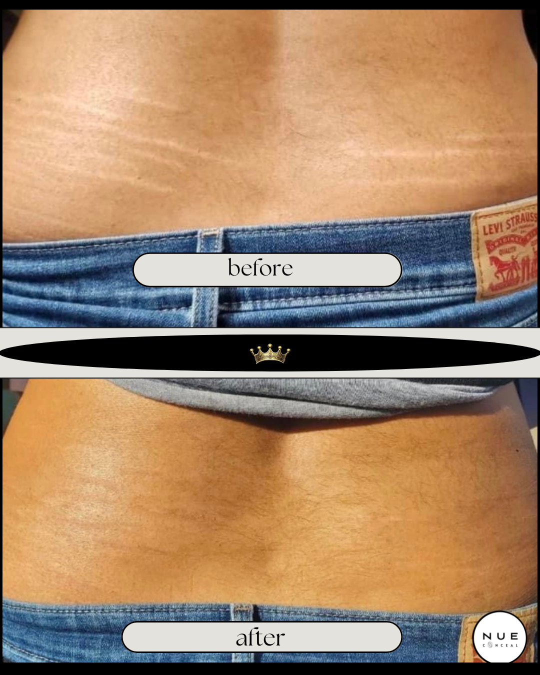 Comparison of a person's lower waist area before and after camouflage and inkless tattoo treatment for stretch marksBoth images include denim jeans and a gray shirt.