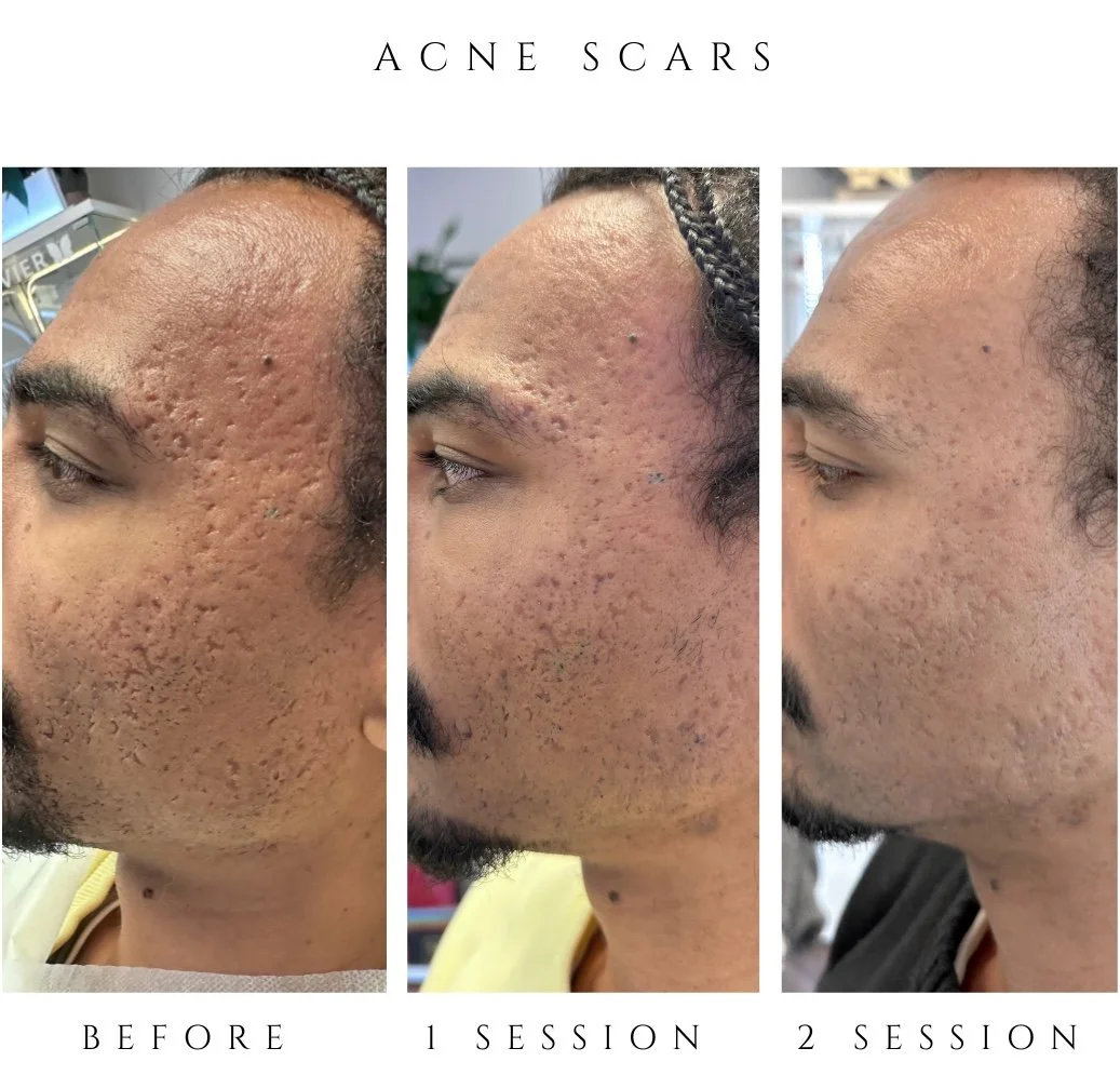Progress photos showing the improvement of acne scars over three stages: before treatment, after one session, and after two sessions.