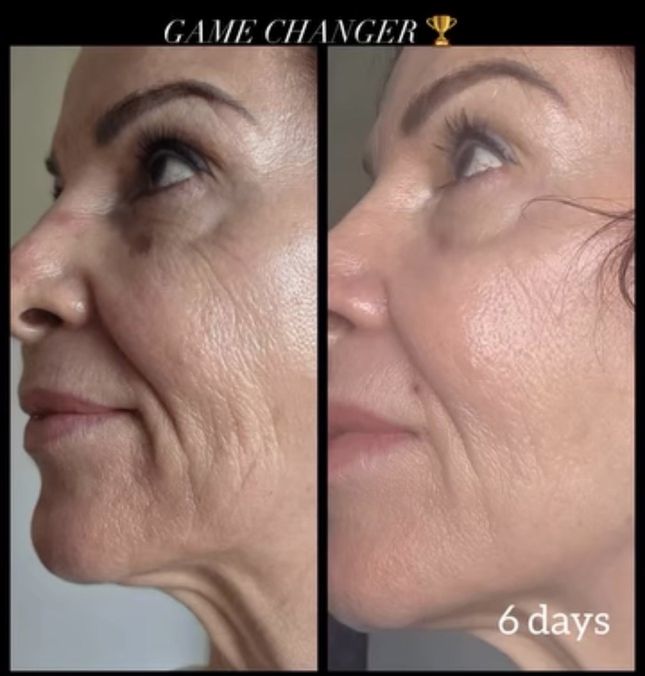 Side-by-side comparison of a woman's face showing skin improvements over six days, with the left side indicating the 'before' and the right side showing clearer skin after treatment.