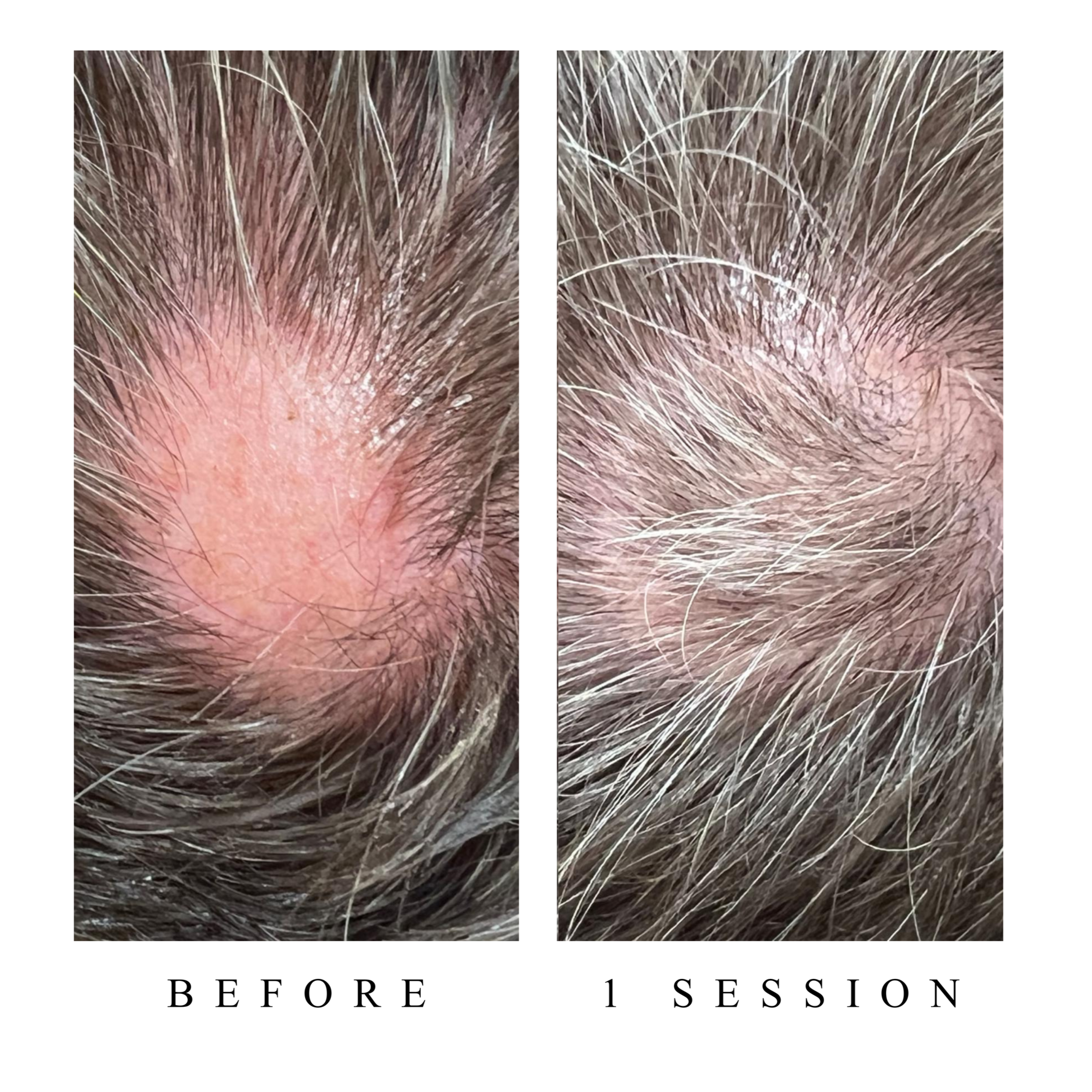 Close-up of scalp with gray hair before a hair treatment session.