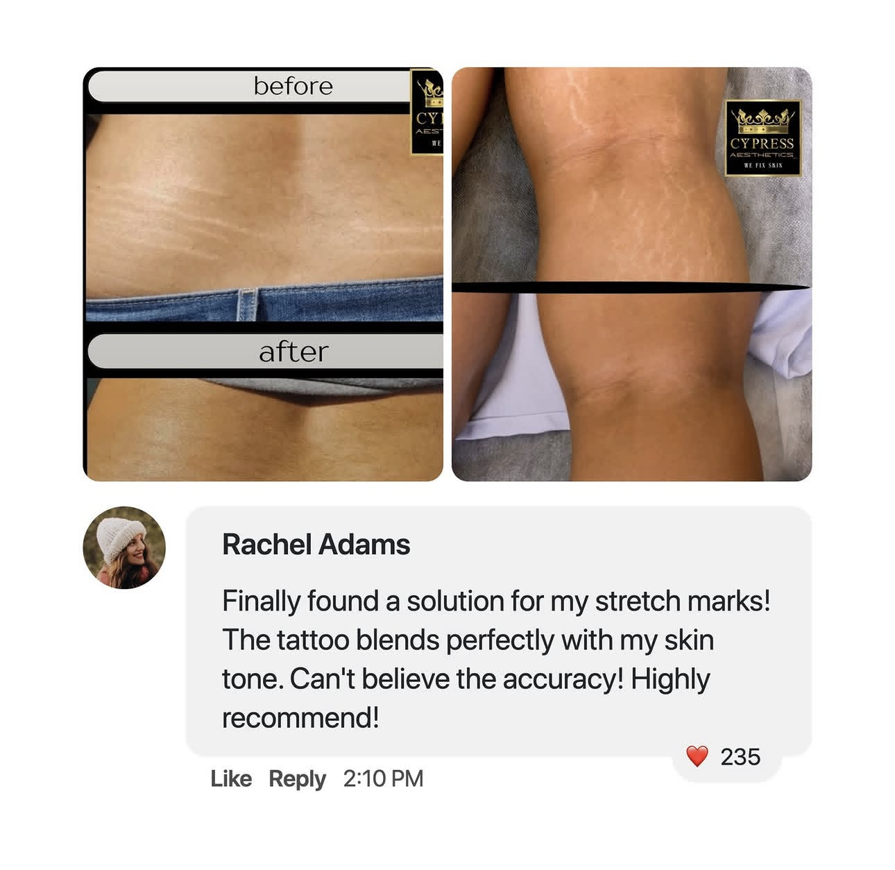 Before and after photos showing the reduction of stretch marks on the skin with a skincare product, accompanied by a testimonial praising the product's effectiveness.