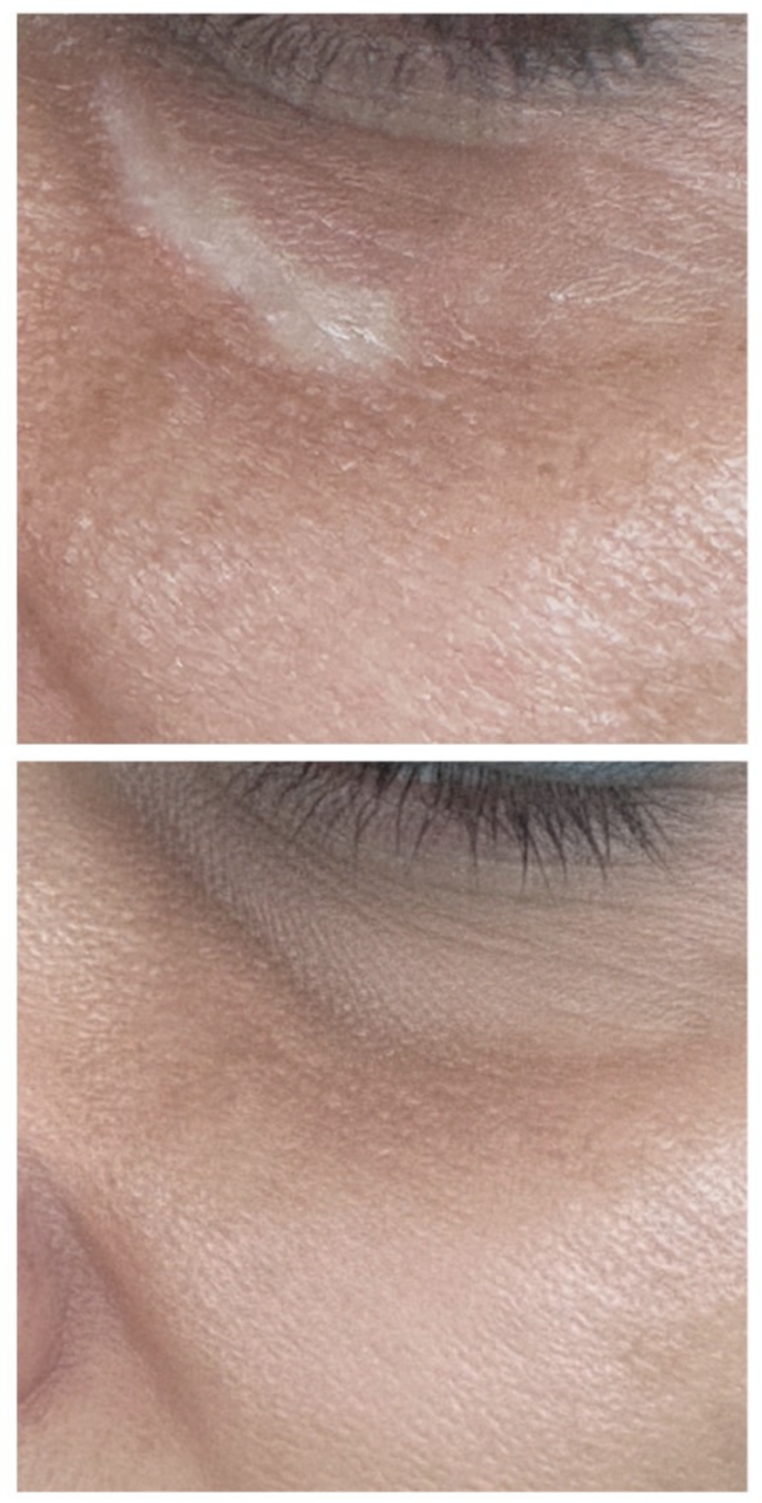 Close-up comparison of skin near a person's eye, showing a transition from dry, flaky skin in the top image to smooth, moisturized skin in the bottom image.