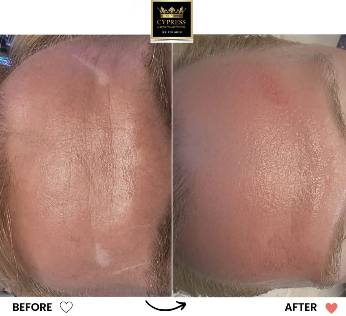 Comparison of forehead skin before and after camouflage tattoo treatment showing clearer, smoother, camouflage skin at Cypress Aesthetics Inc.