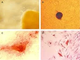 PRP vs. Umbilical Cord-Derived Extracellular Matrix (ECM) Allograft: Why I Often Choose an Extracellular Matrix Approach for Chronic Tendon Injuries *Educational Purposes Only*
