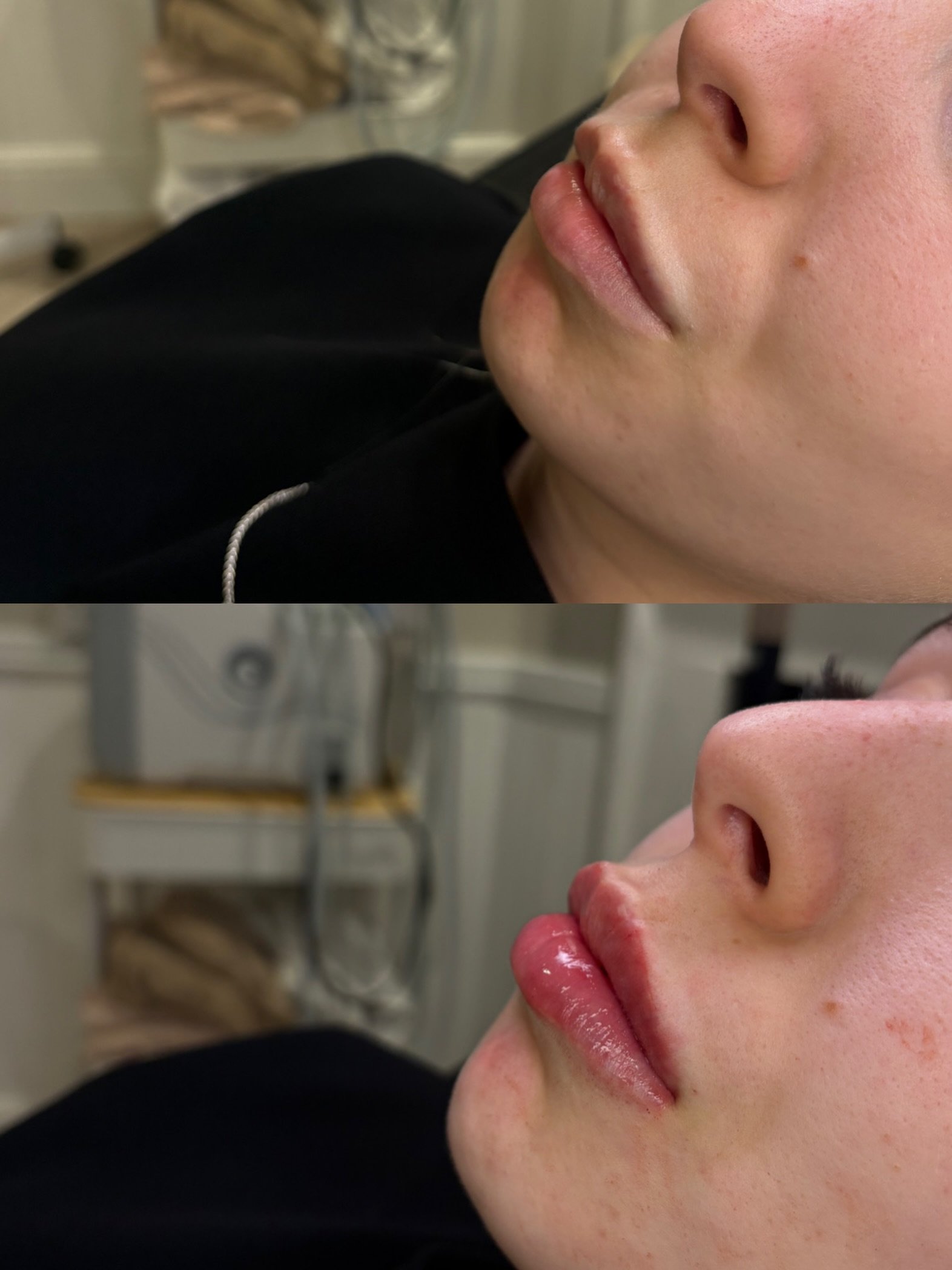 The difference 😍 1ml used here 👄

𝘉𝘺 𝘊𝘳𝘪𝘴𝘵𝘪𝘯𝘢