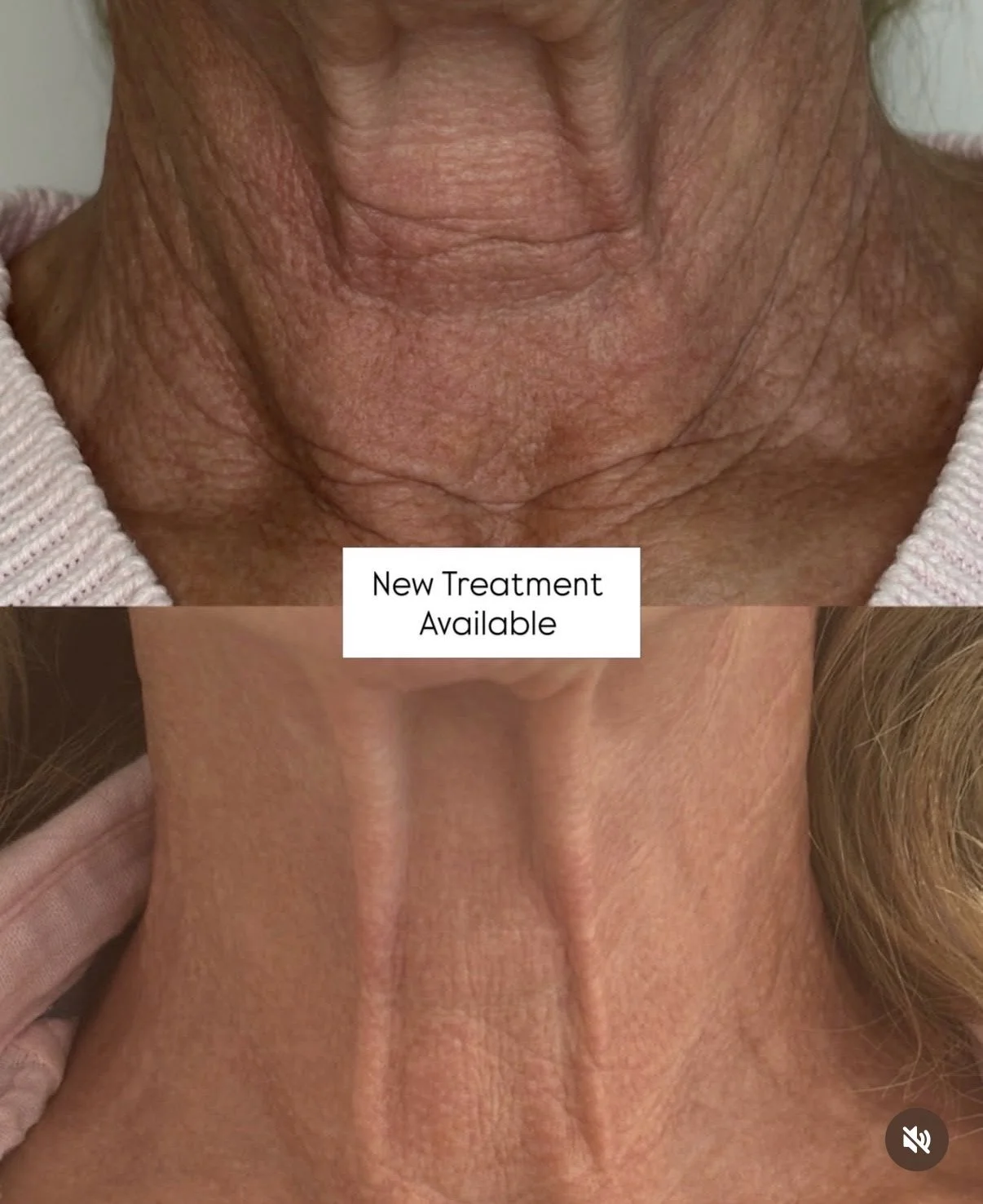 Understanding Collagen Loss