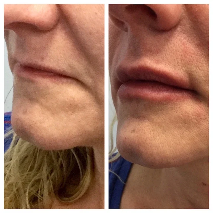 Juvederm Ultra XC - after one syringe*