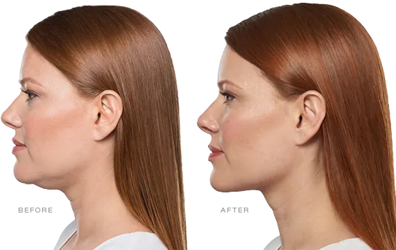 Kybella