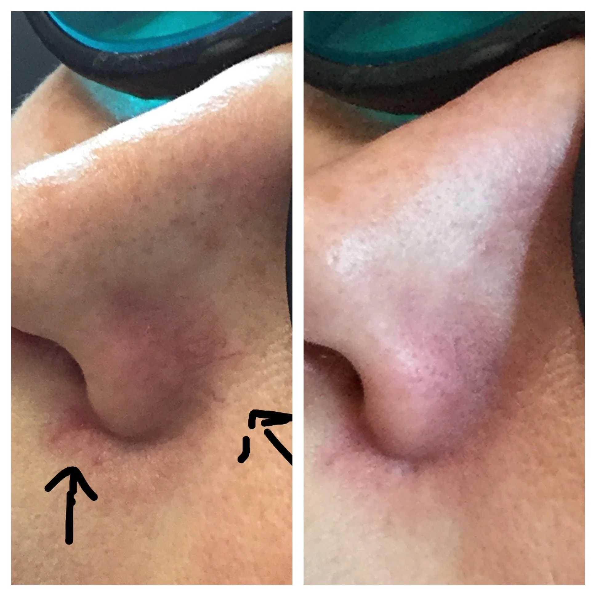 Laser treatment for facial veins*