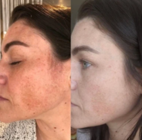 VI Peel Purify with Precision Plus