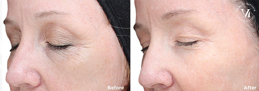 VI Peel Advanced