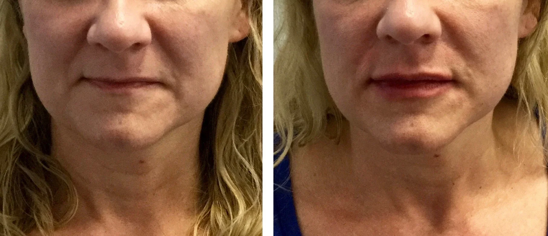 Juvederm Ultra XC - after one syringe*