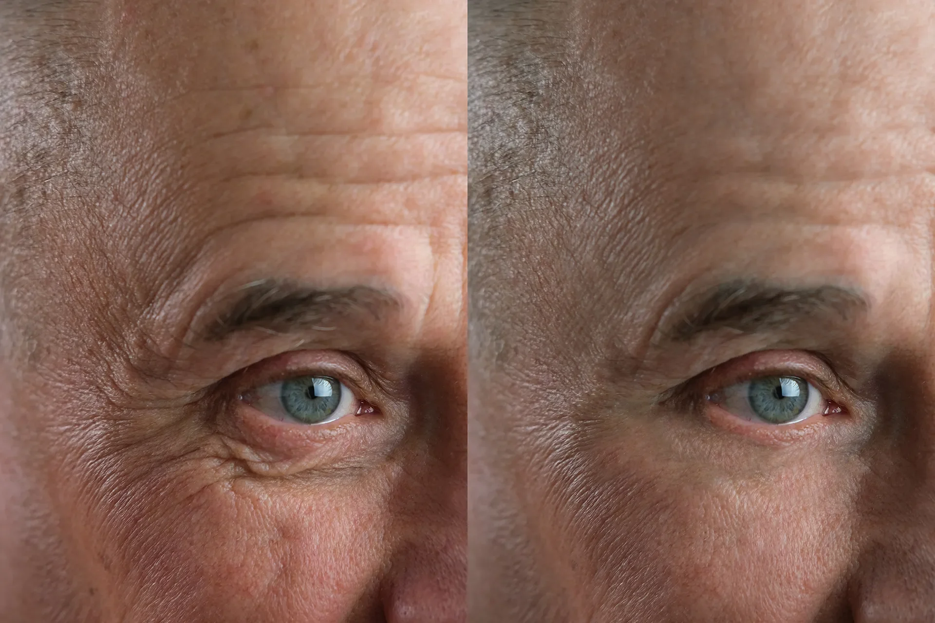 Botox