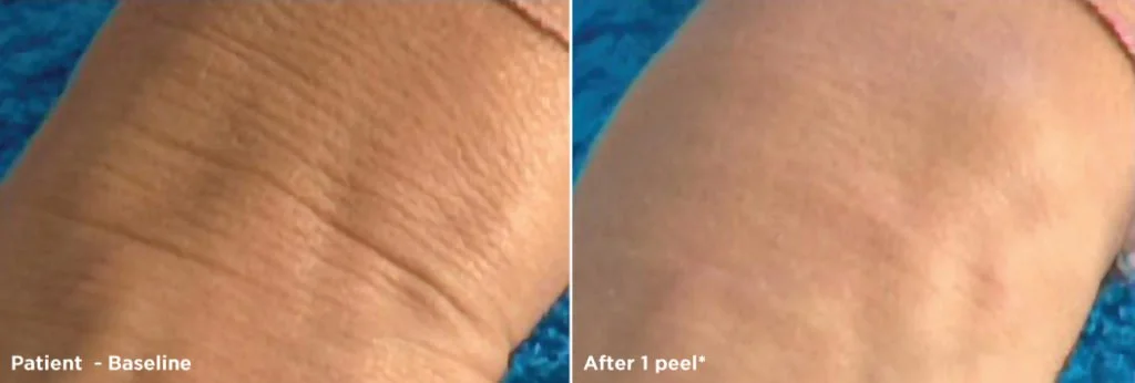 Glytone Hand Peel