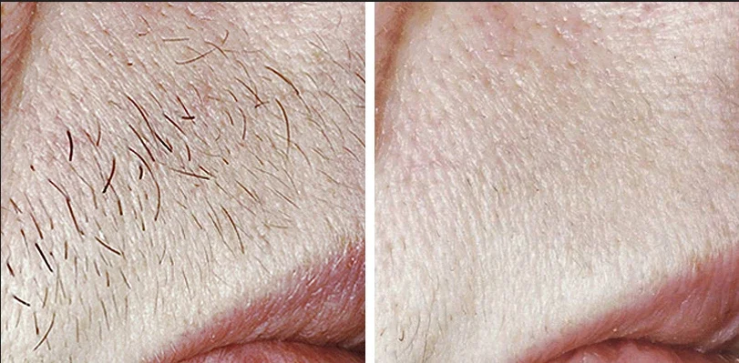 Laser Hair Removal*