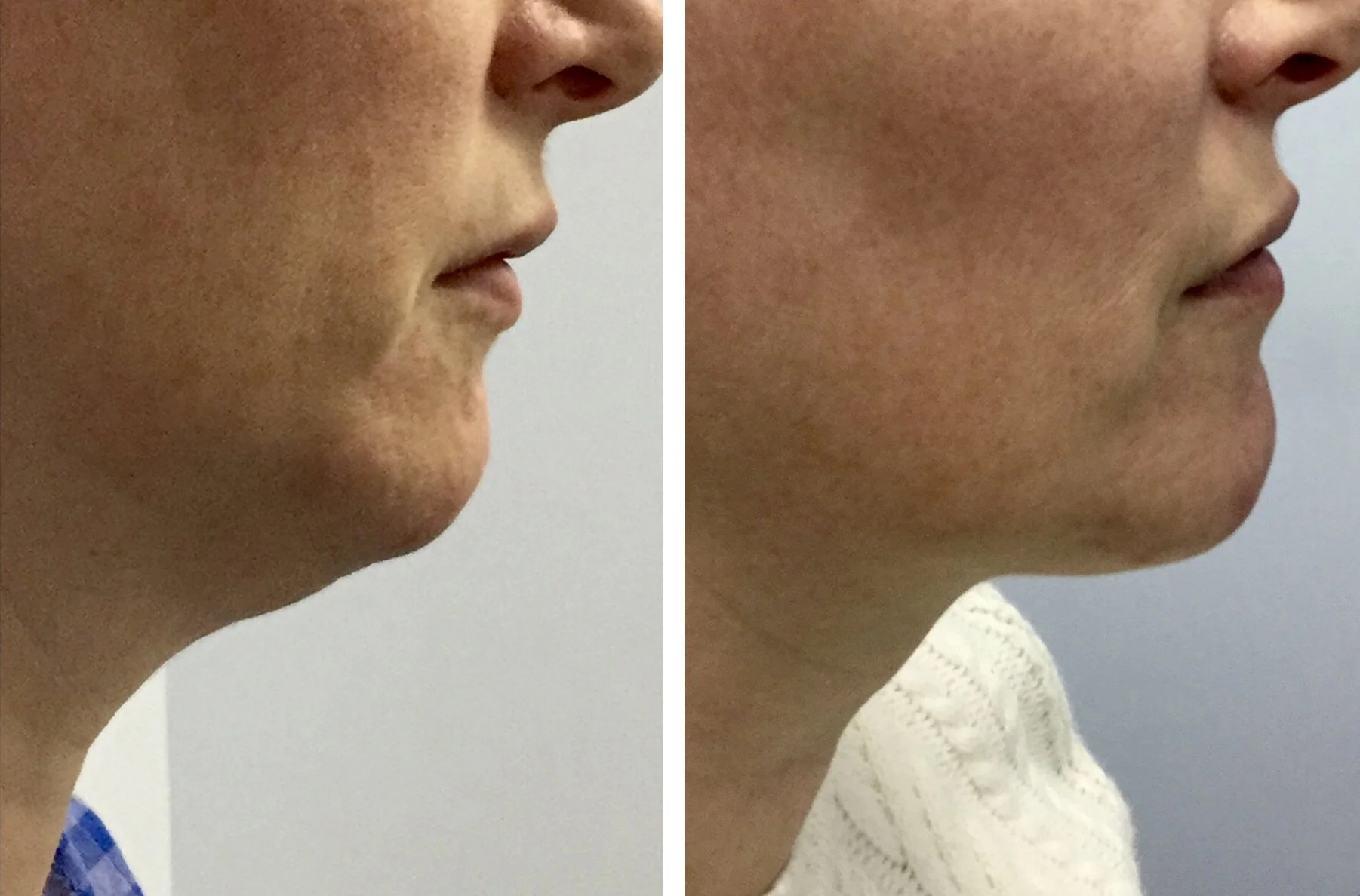 Kybella - after 2 treatments*