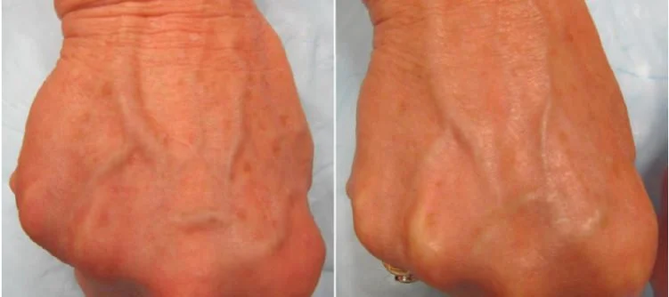 Pigmented Lesions
