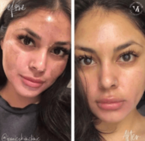 VI Peel Precision Plus