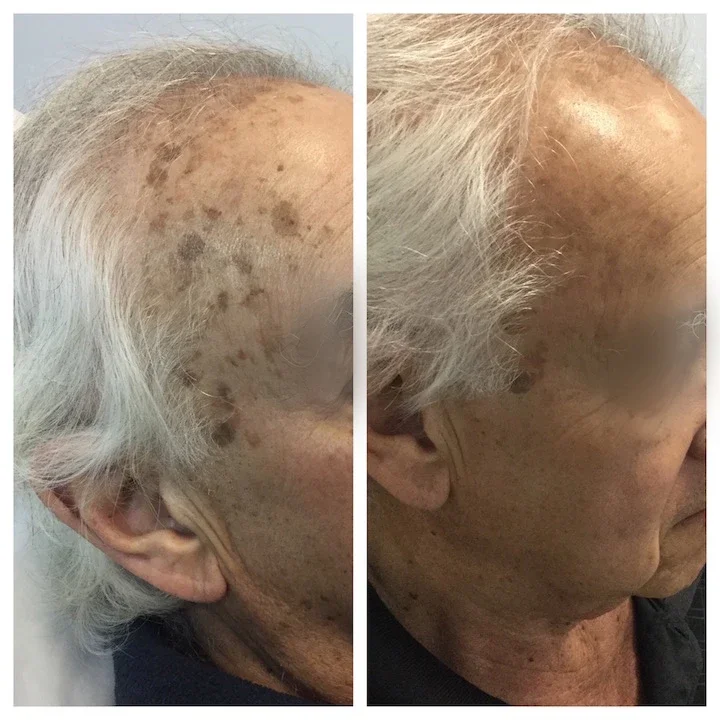 Pigmented Lesions*