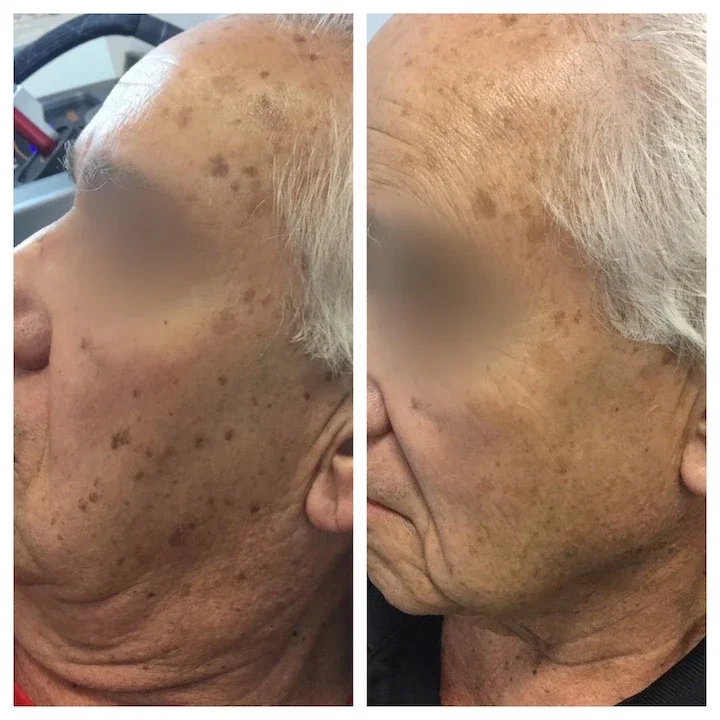 Pigmented Lesions*