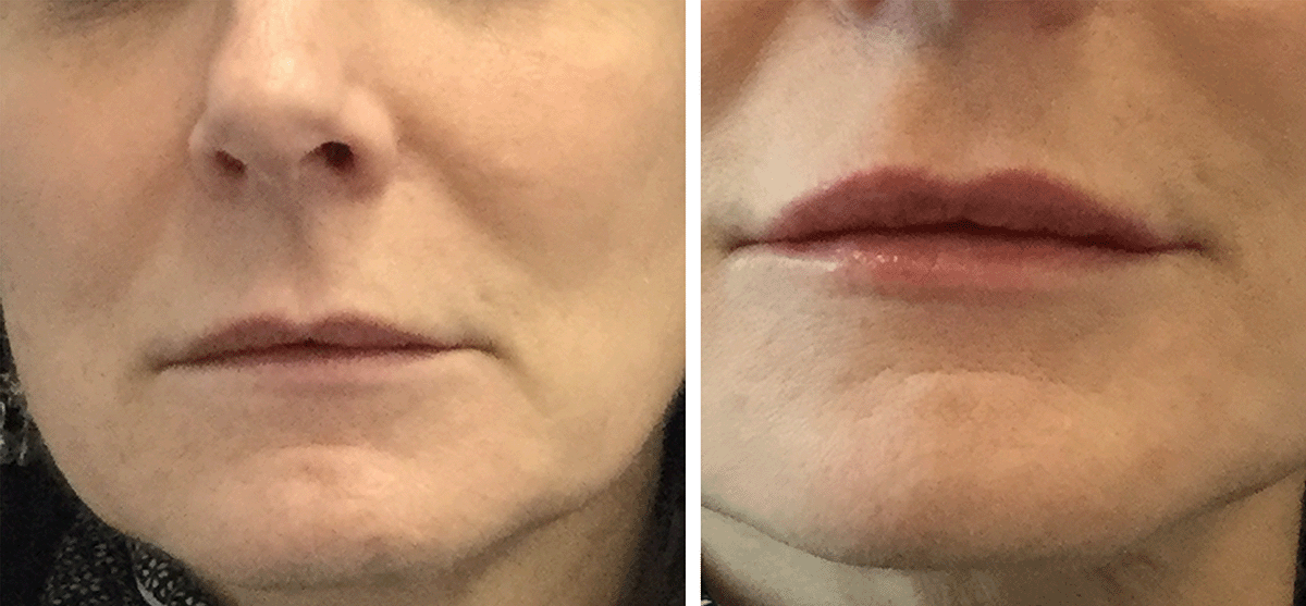 Subtle Lip Augmentation*