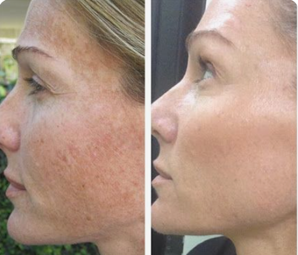 VI Peel Purify with Precision Plus
