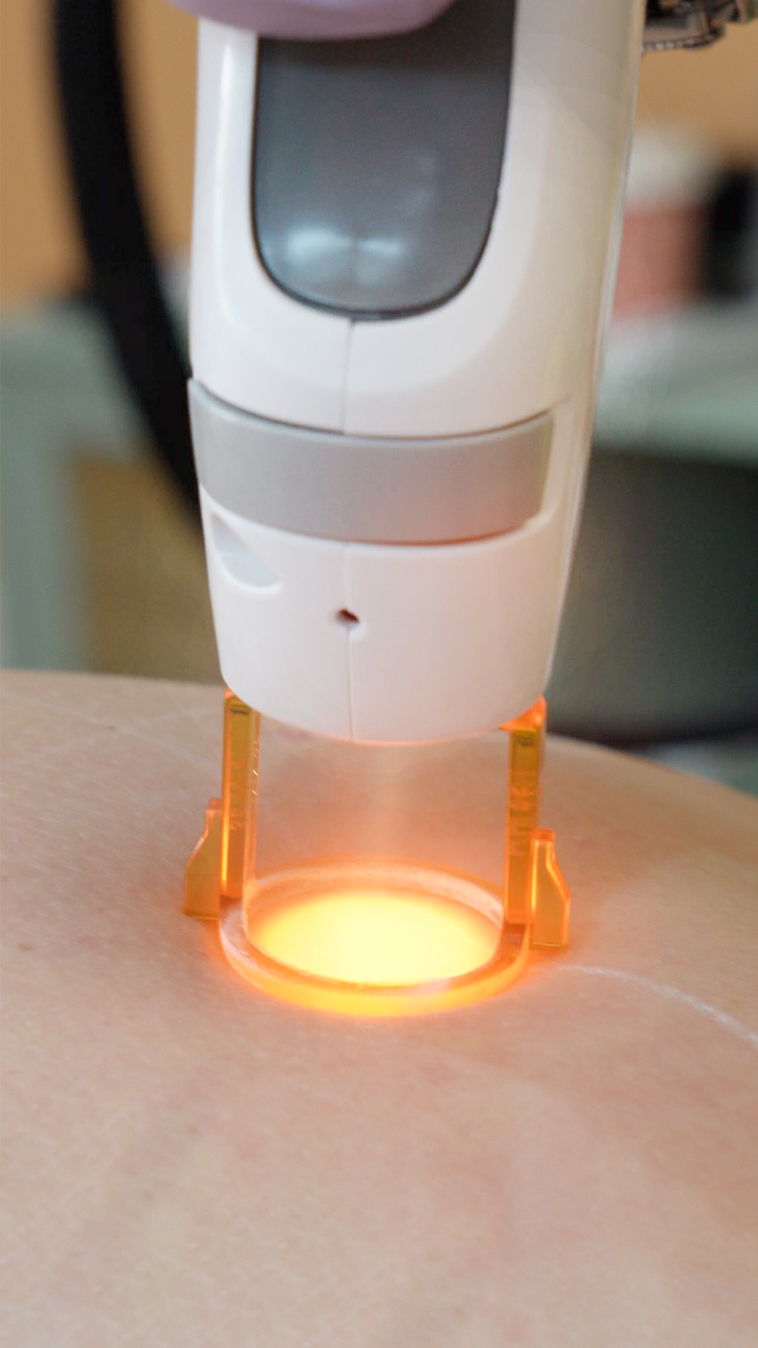 The gold-standard Candlea GentlePro Max Plus medical-grade device performing an laser hair removal on skin, with an orange light illuminating the area showing the energy targeting the hair follicle