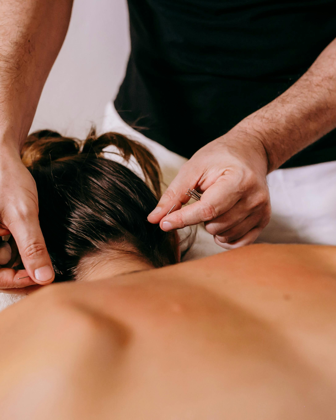 A person receiving acupuncture treatment, with a practitioner inserting thin needles into their back.