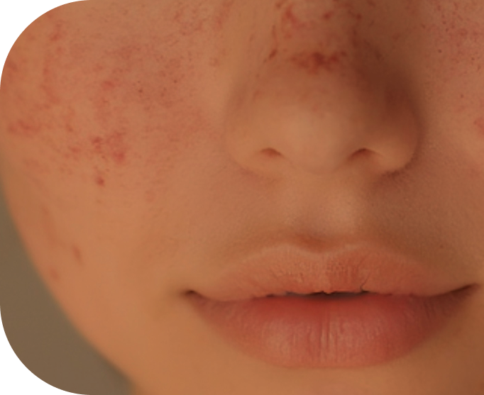 Nahaufnahme eines sommersprossigen Gesichts mit vollen Lippen als ästhetisches Coverbild für einen Kurs in ästhetischer Medizin