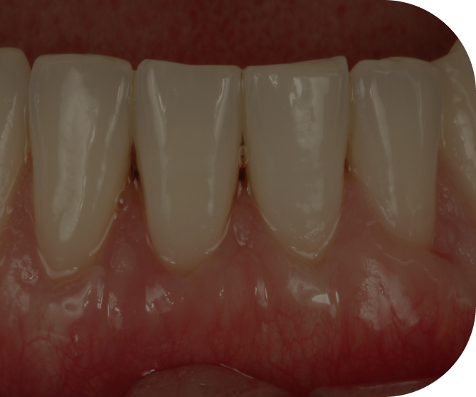 Ergebnis nach erfolgreicher Rezessionsdeckung mit harmonischem Zahnfleischverlauf als Coverbild für zahnmedizinische Fortbildungskurse