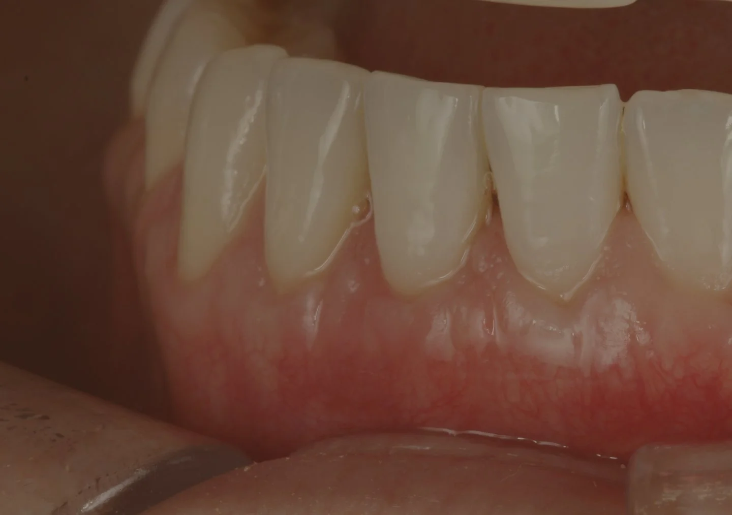 Rezessionsdeckung: Grundlagen und Techniken