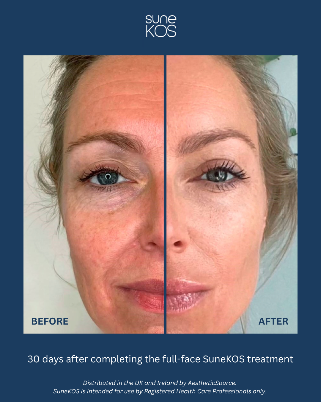 A side-by-side comparison of a woman's face before and after 30 days of SuneKOS full-face treatment, showing reduced wrinkles and improved skin texture.