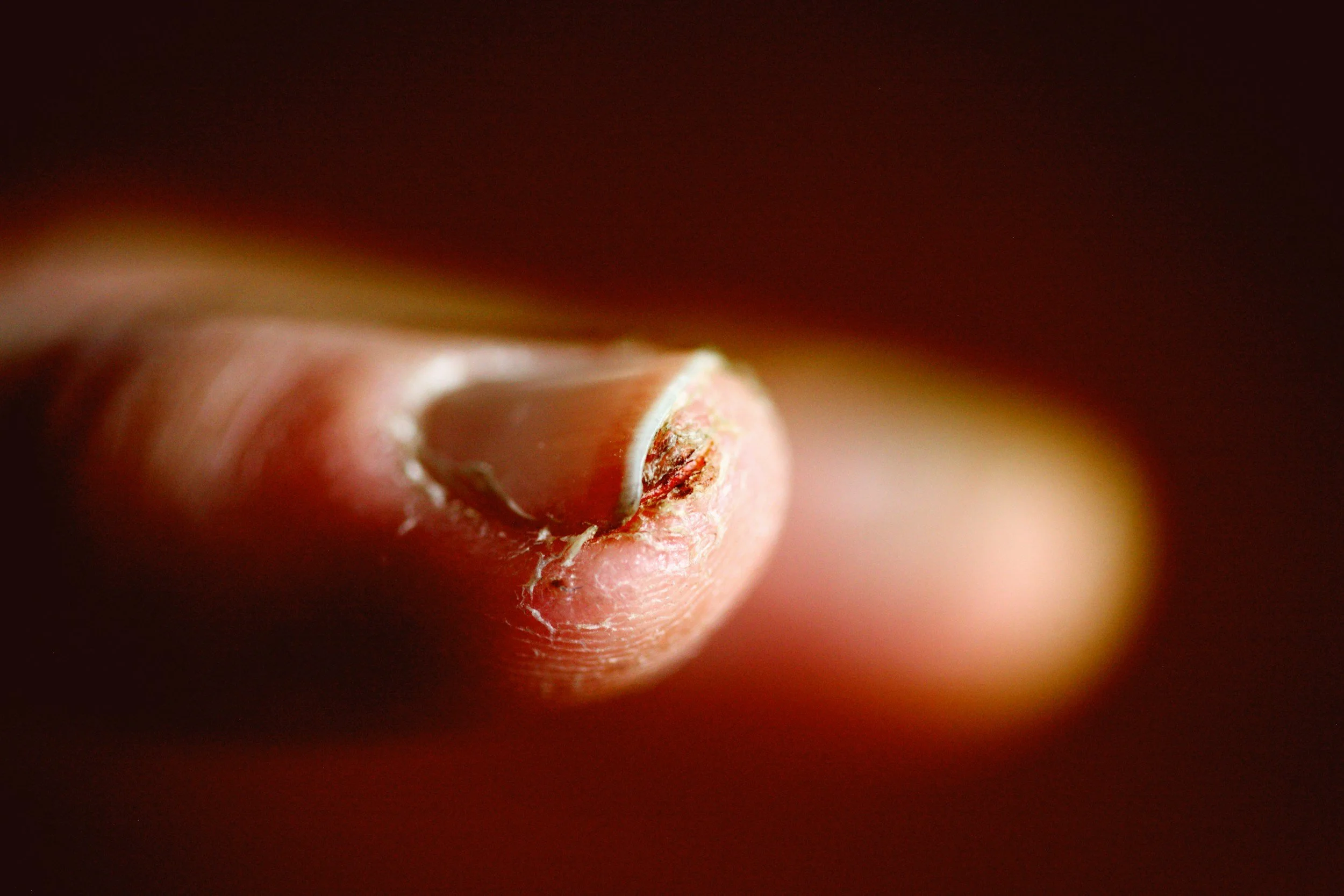 Close-up of a damaged fingernail with peeling skin and redness.