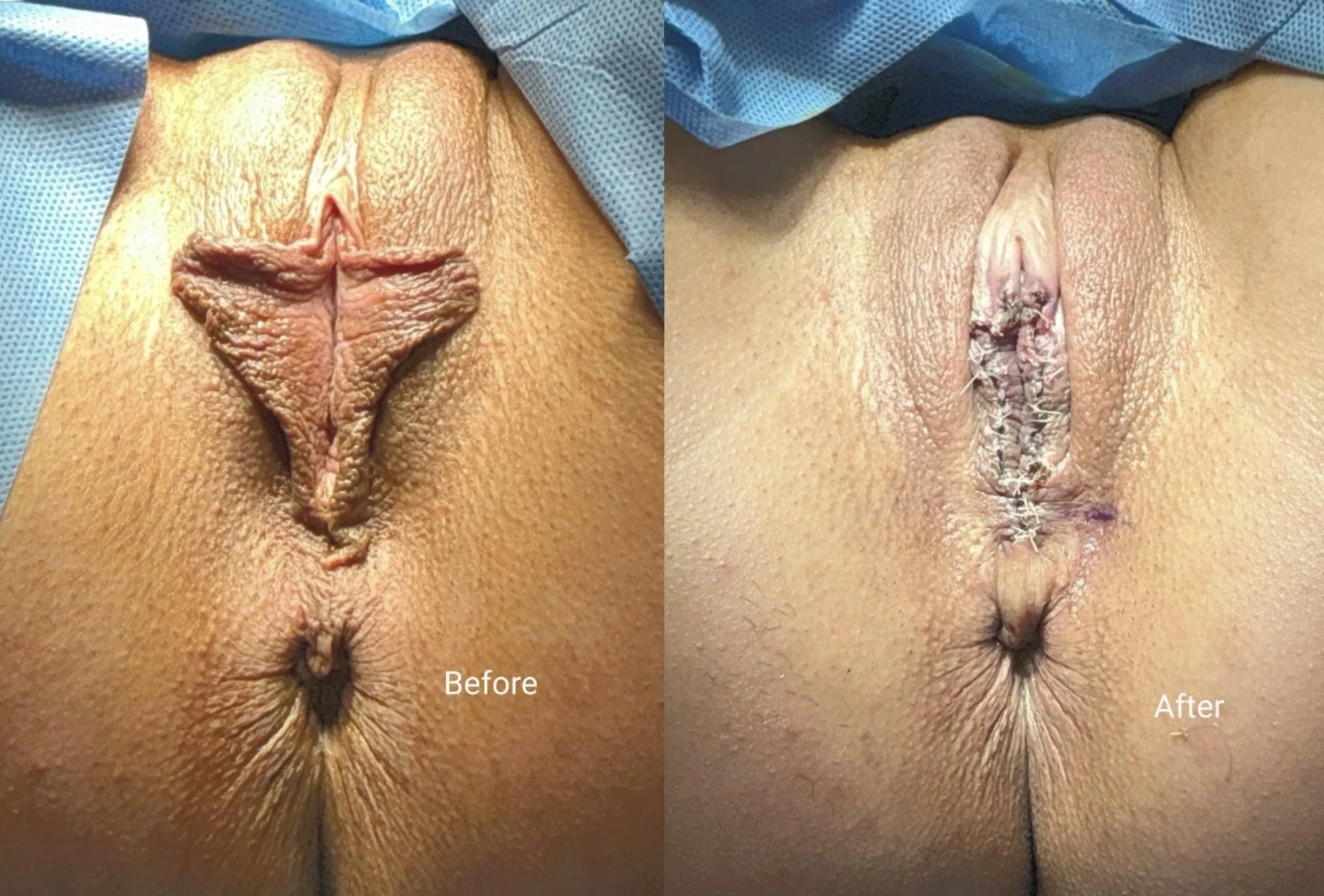 Labiaplasty_results_sugar land medical spa.jpeg