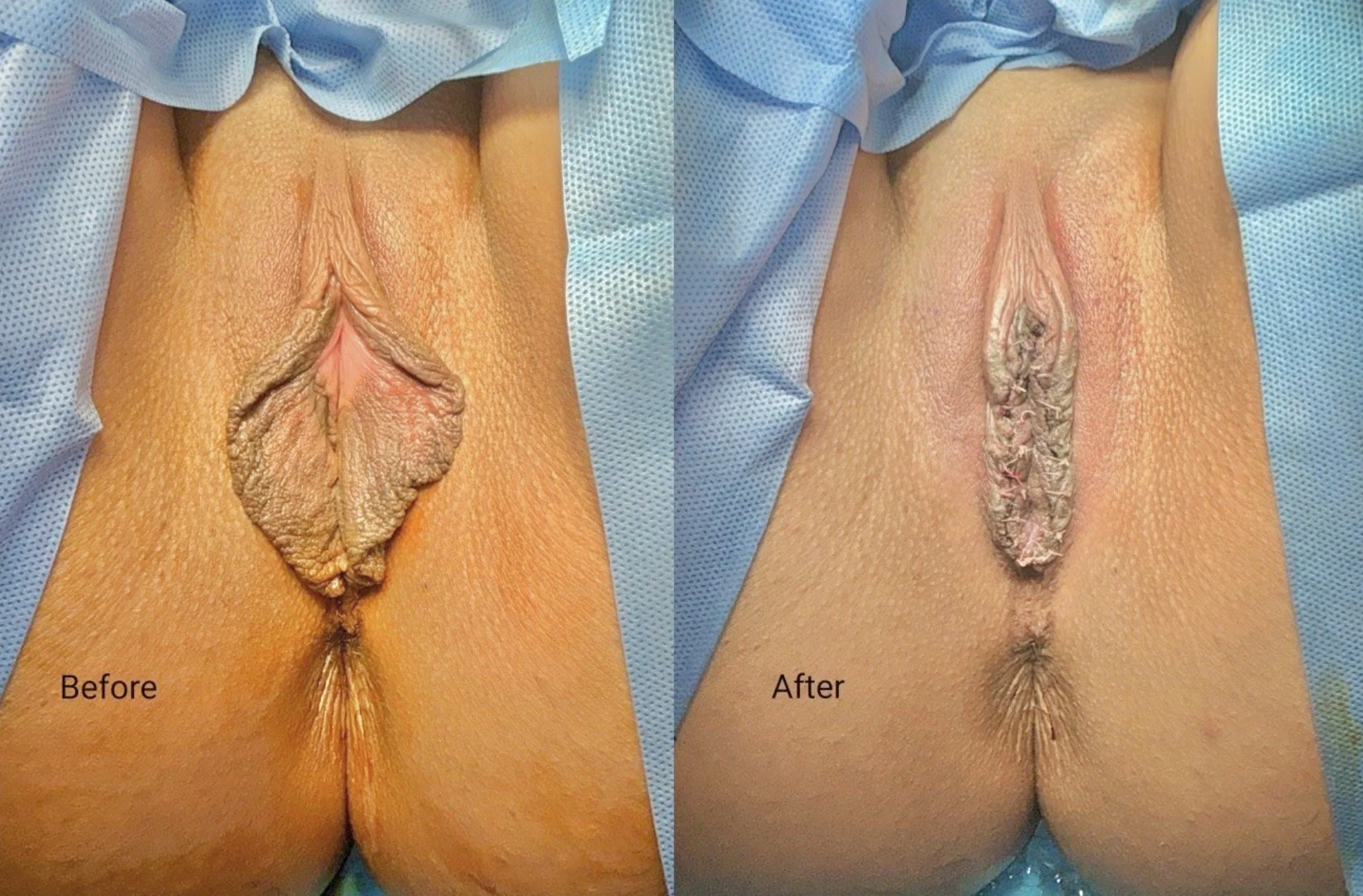 Labiaplasty_results_medical_spa sugar land houston.jpeg