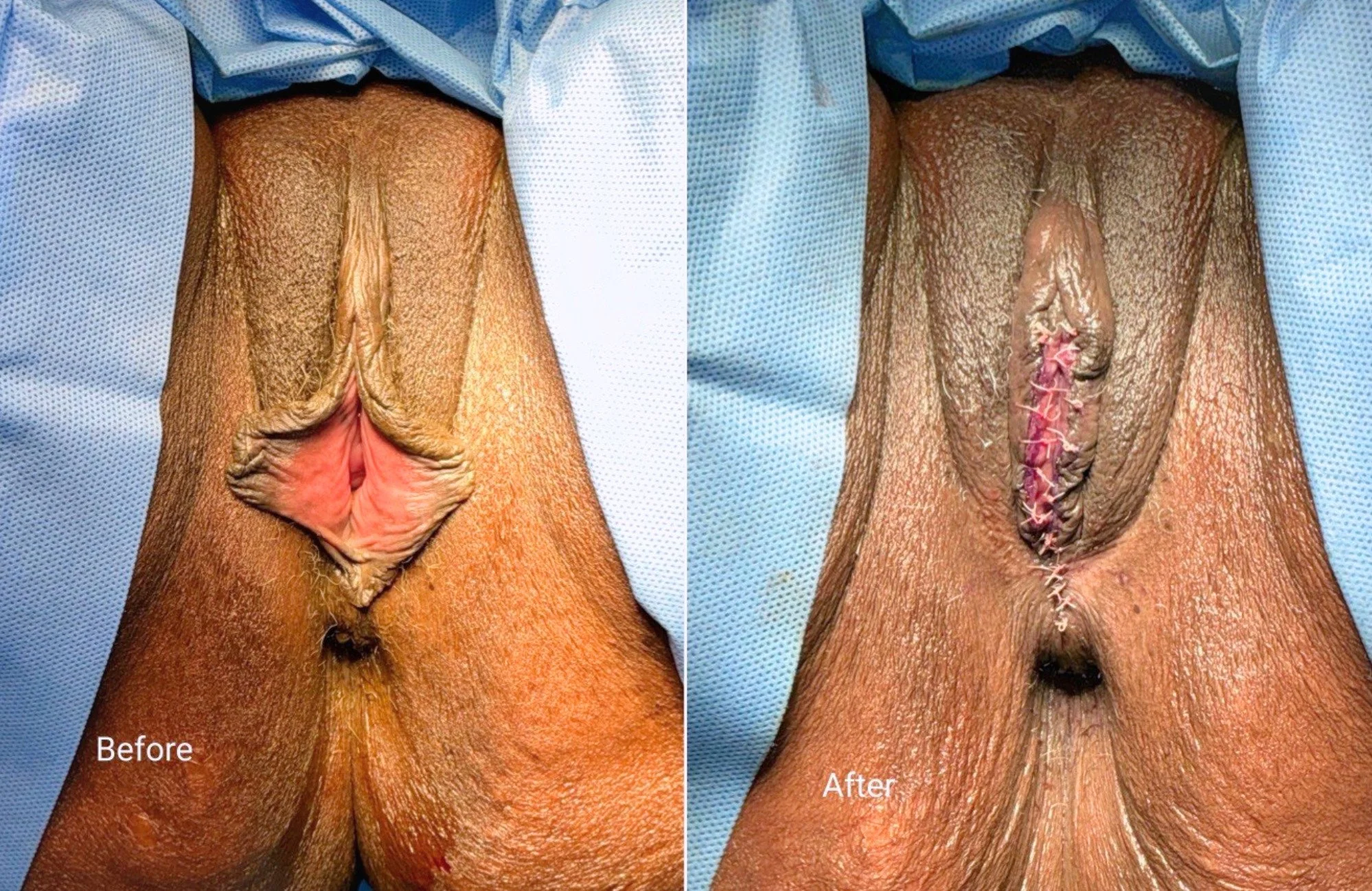 labiaplasty-before-and-after-houston.jpeg