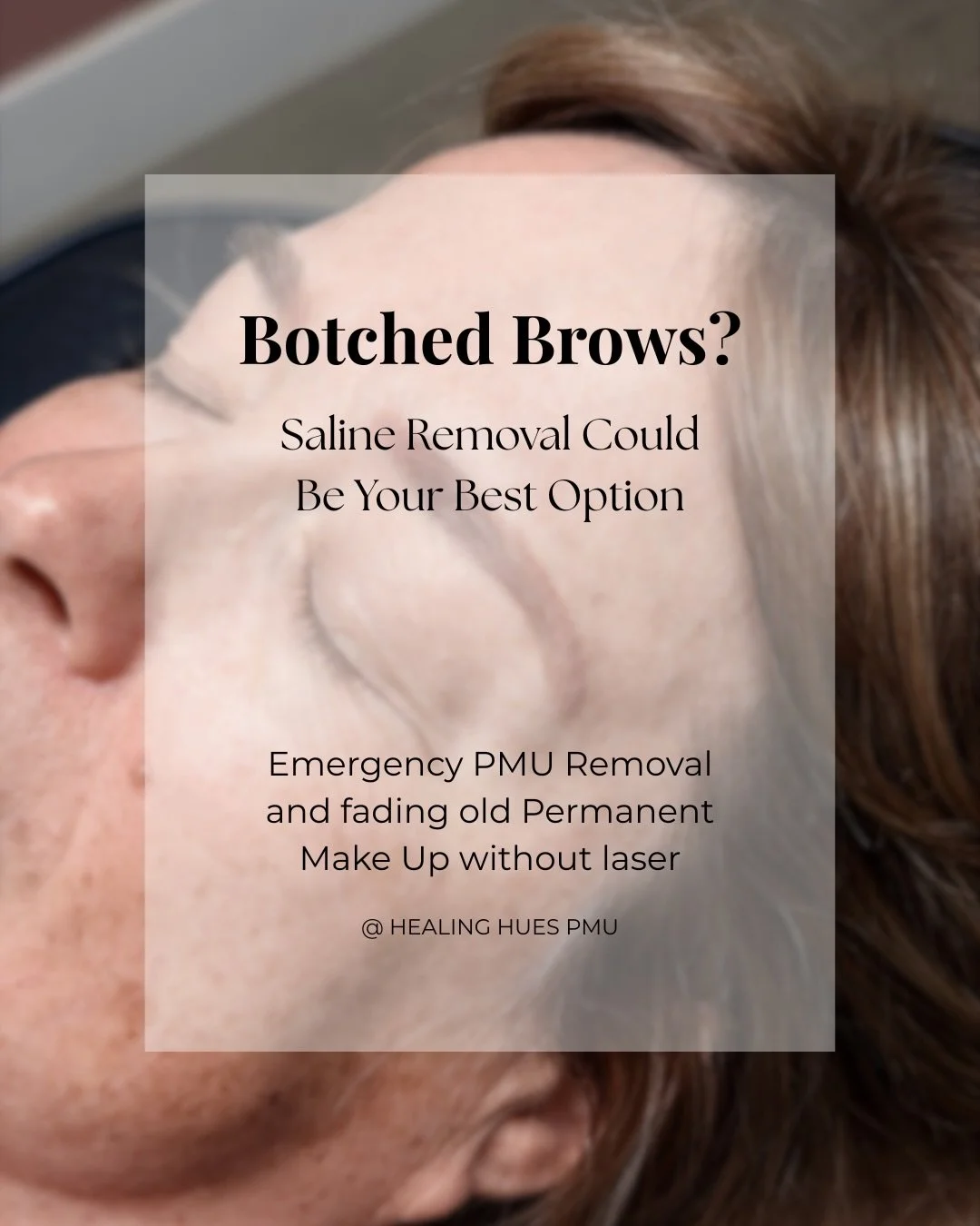 Not loving your permanent makeup? You may have options. 🤔

Saline tattoo removal can be used for emergency PMU removal after a fresh procedure or to gradually lighten older permanent makeup that no longer fits your style.

Whether you&rsquo;re deali
