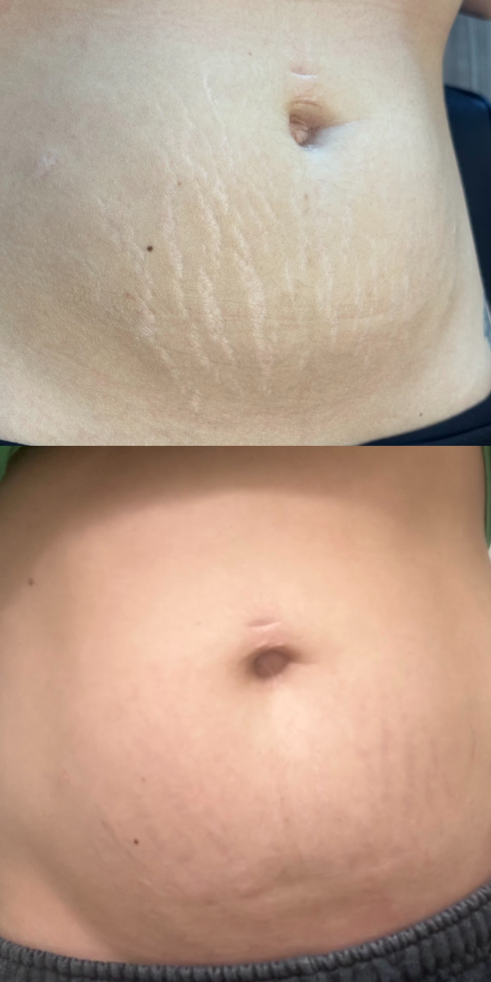 Before and after photo of person with paramedical tattoo treatment.