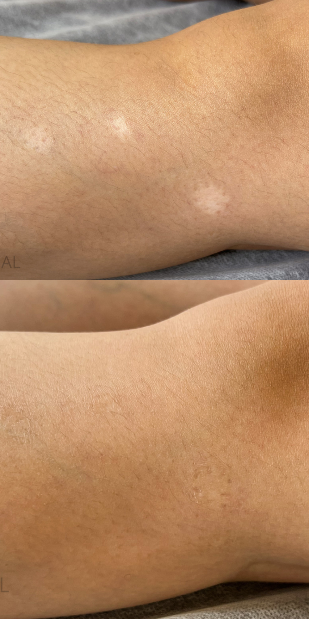 Before and after photo of person with paramedical tattoo treatment.