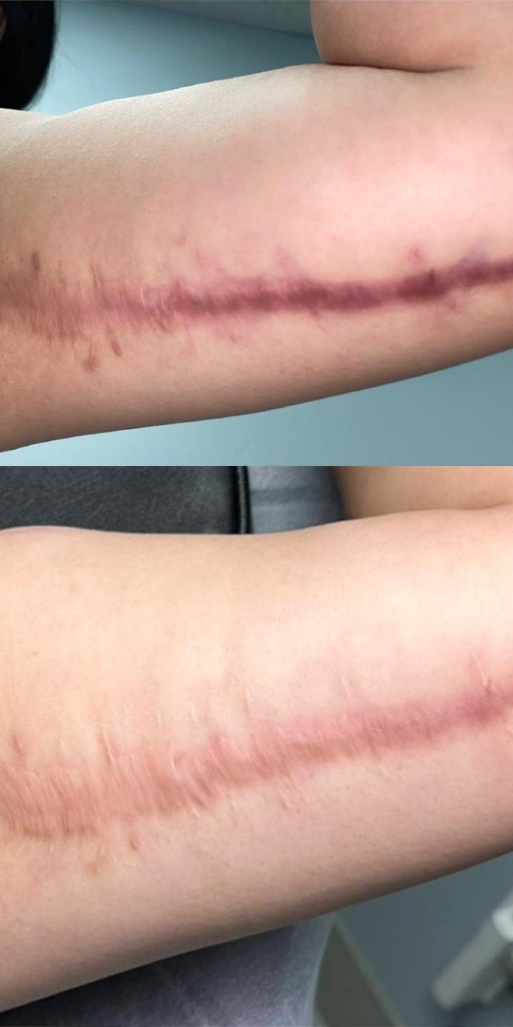 Before and after photo of person with paramedical tattoo treatment.