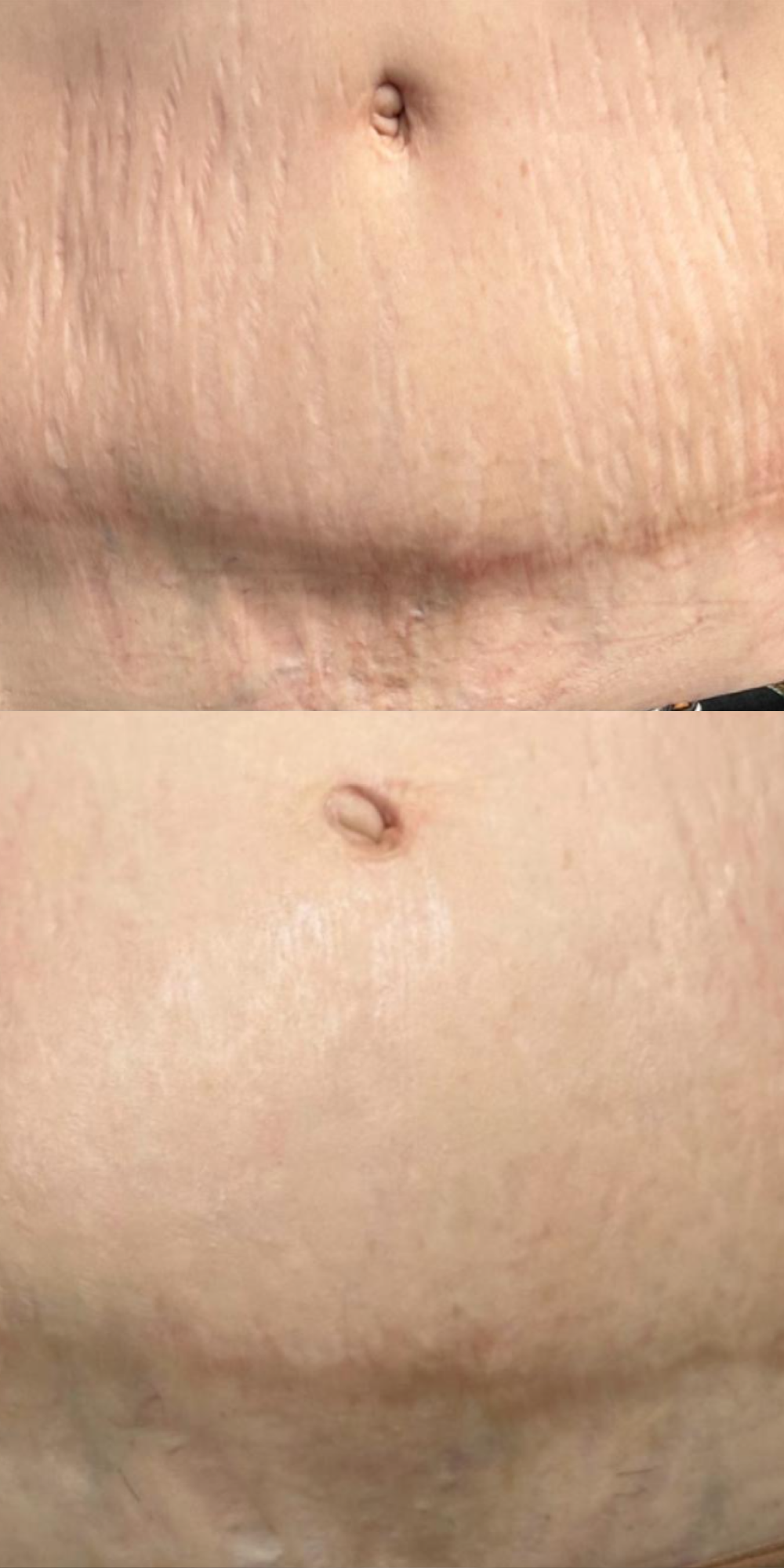 Before and after photo of person with paramedical tattoo treatment.